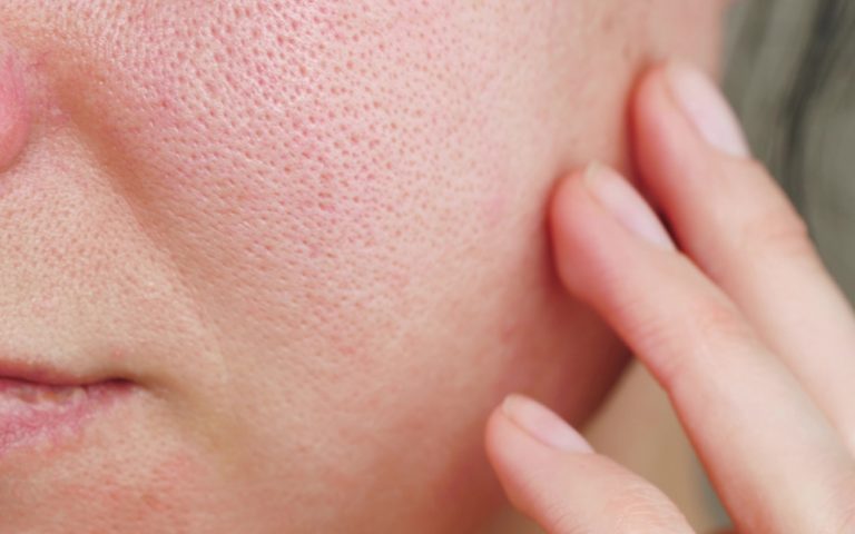 Sensitiv hud / Rosacea